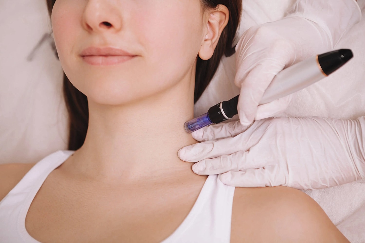 What Is Potenza RF Microneedling?[] How Long Does Potenza Microneedling Last? []