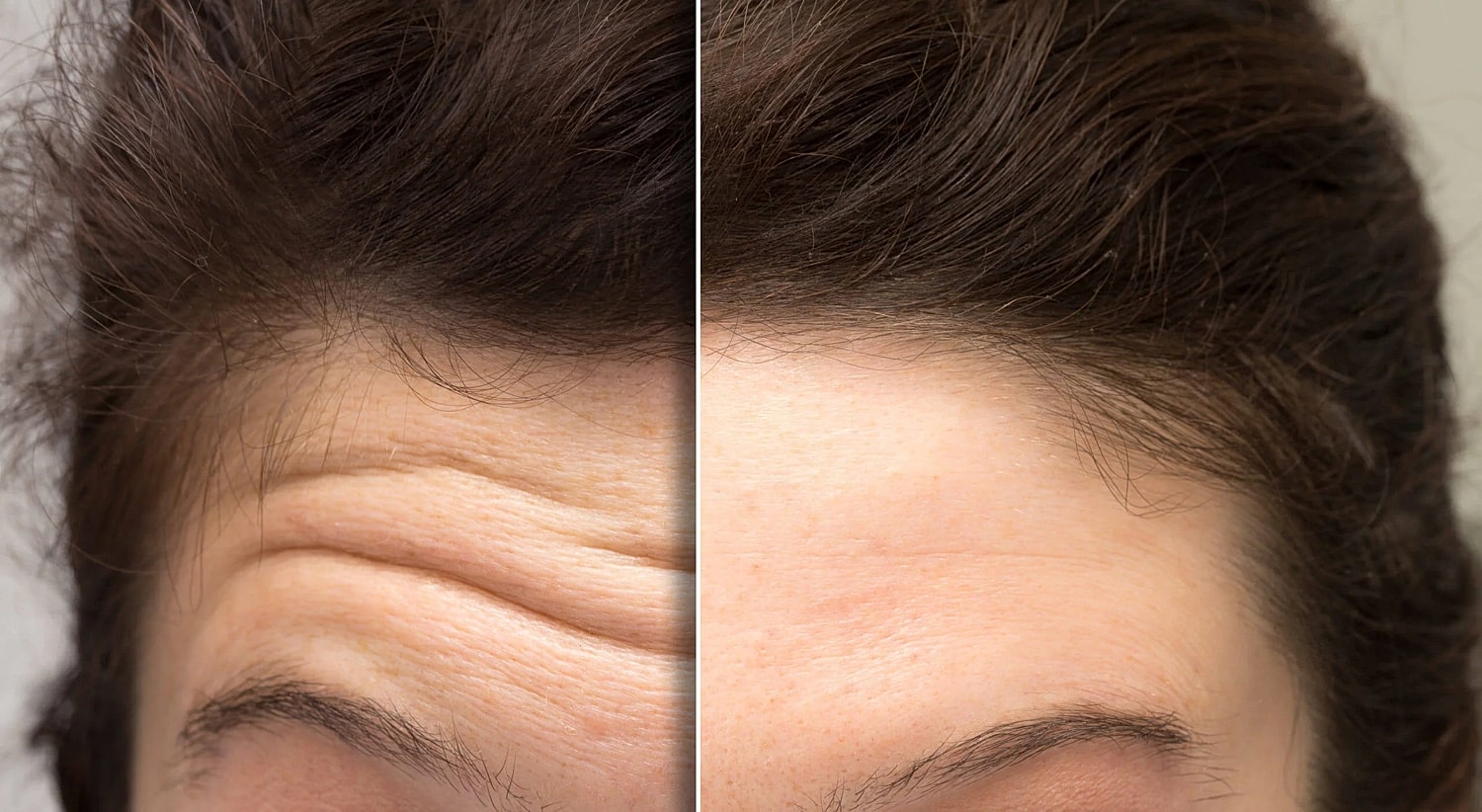[] Which is Better in Removing Wrinkles: []Botox or Dysport?