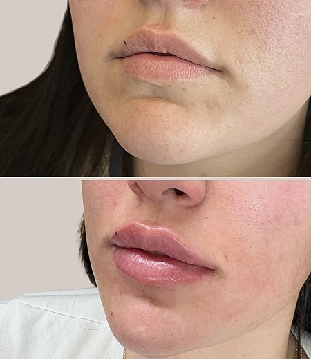 Before and after lip enhancement treatment.