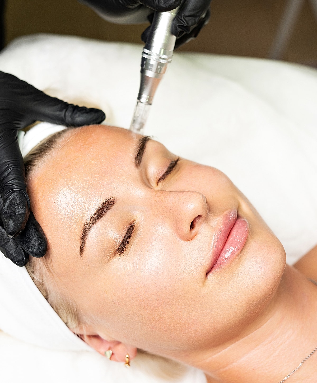Woman receiving a facial treatment with microneedling.