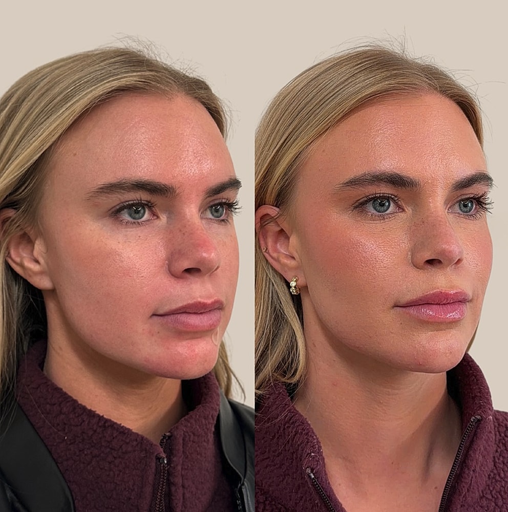 Before and after facial skincare or makeup transformation.