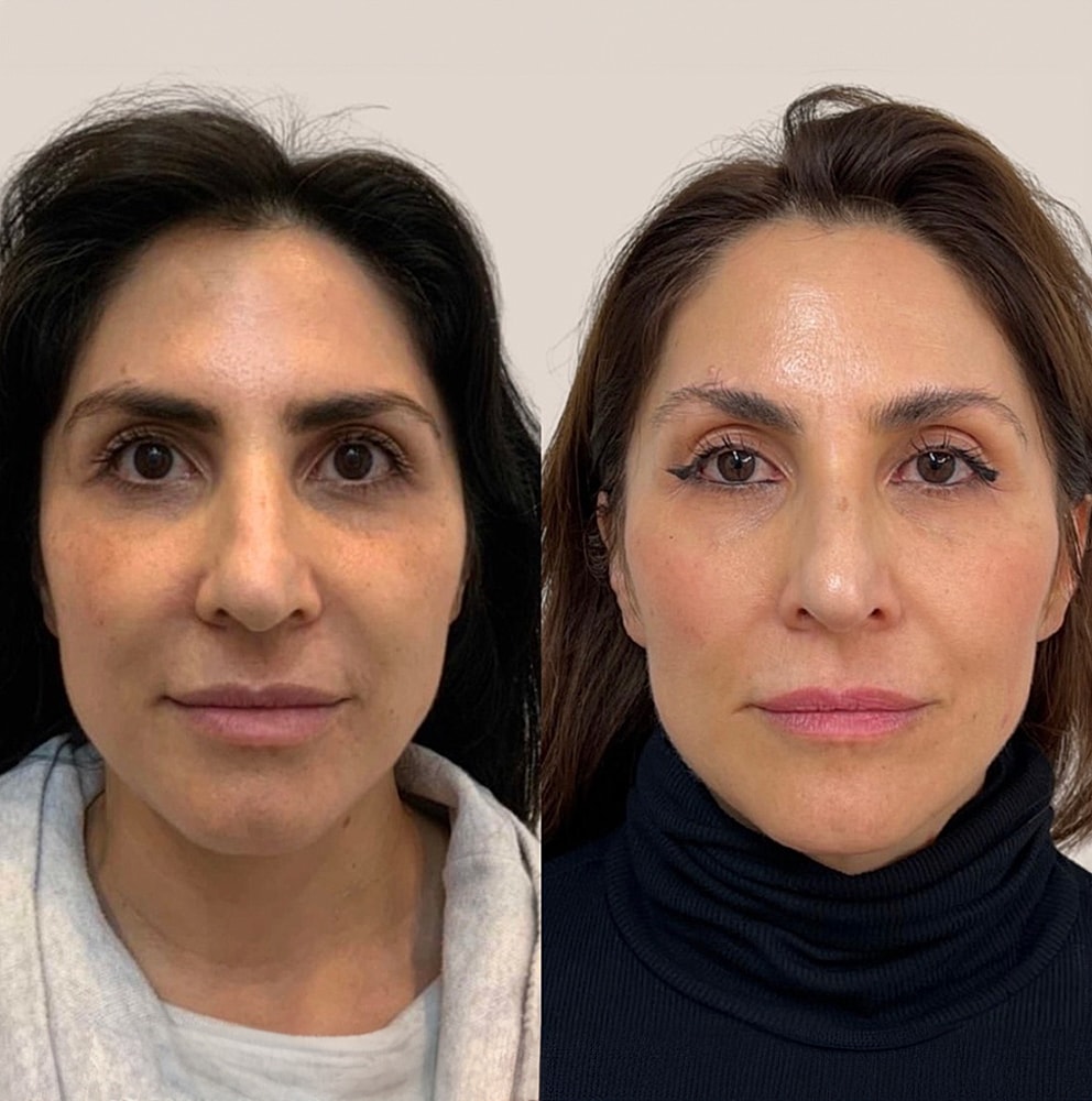 Before and after facial treatment comparison.