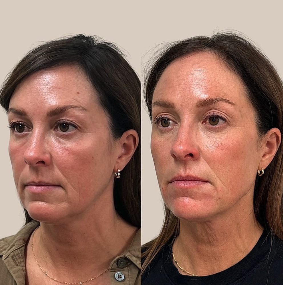 Before and after facial enhancement comparison.