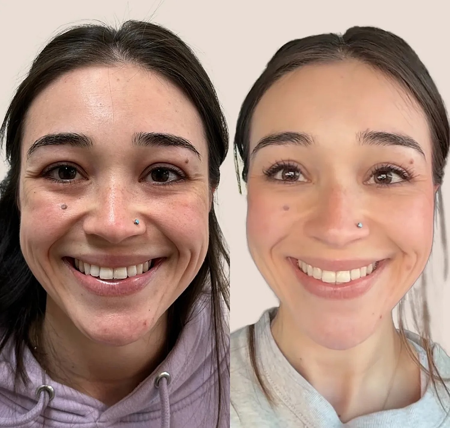 Before and after facial transformation smiling images