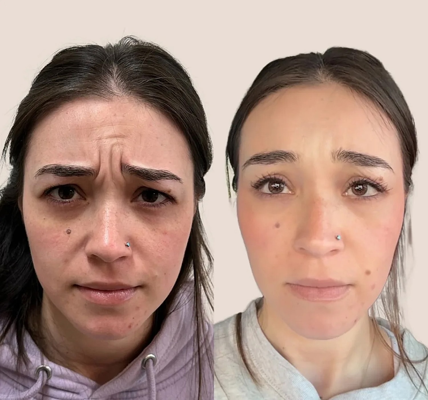 Before and after facial expression comparison.