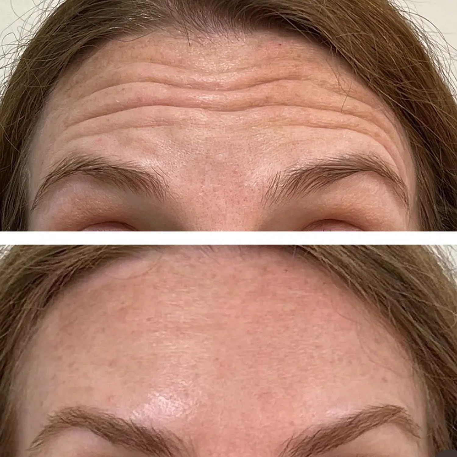 Forehead wrinkles before and after treatment comparison.