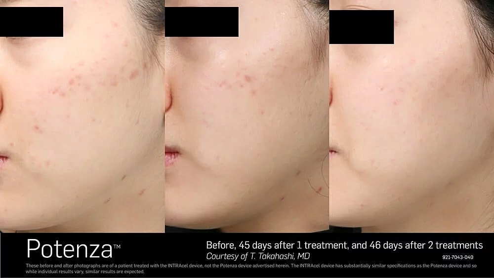 Before and after skin treatment results.