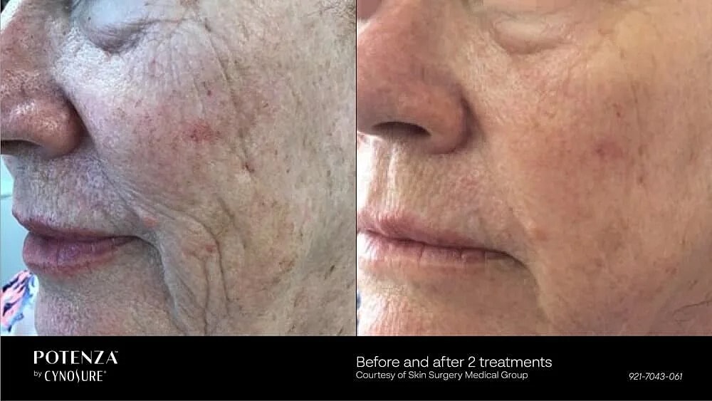 Before and after skin treatment comparison photo.