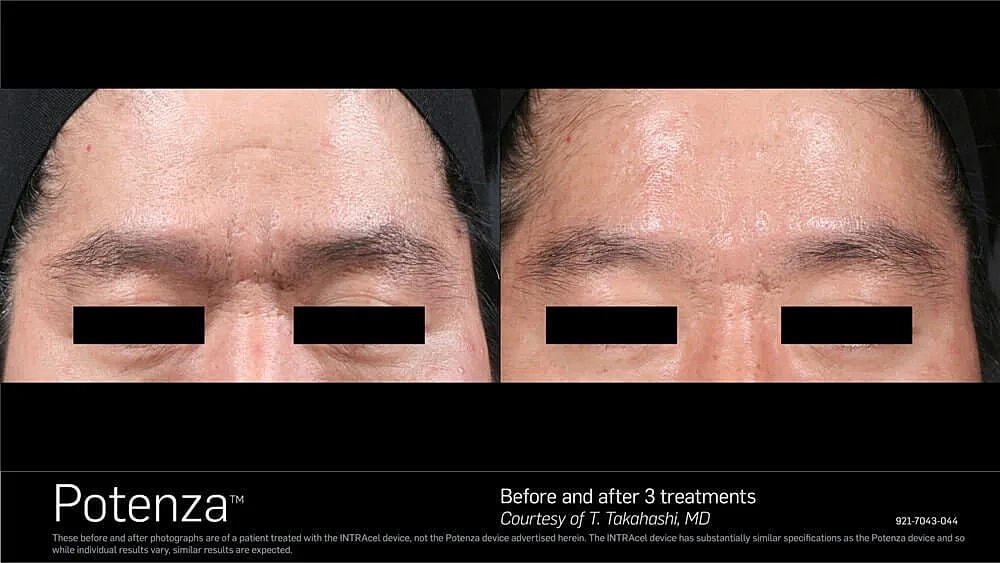 Before and after skin treatment results.