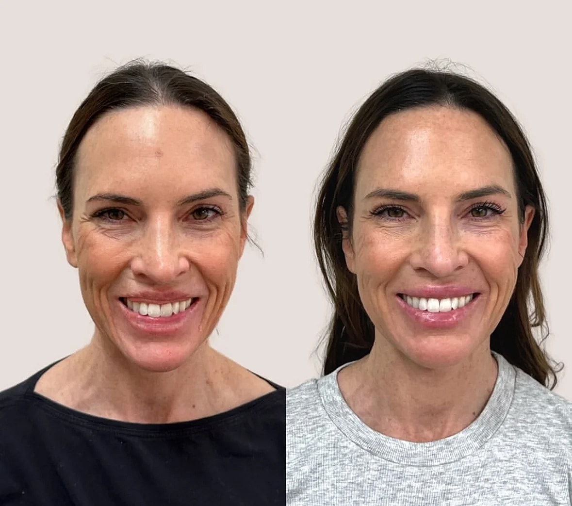 Before and after facial improvement comparison.