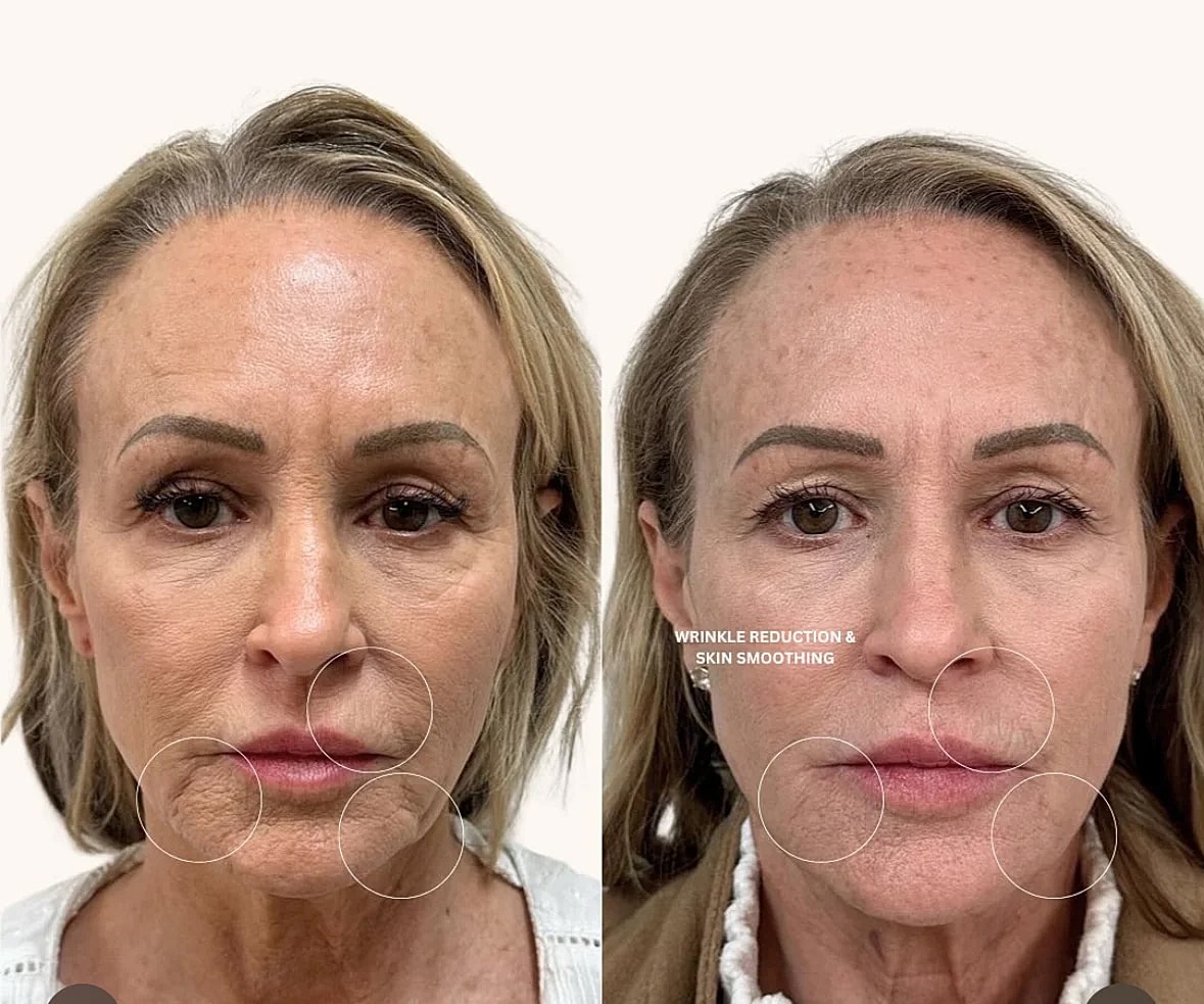 Before and after wrinkle reduction treatment comparison.