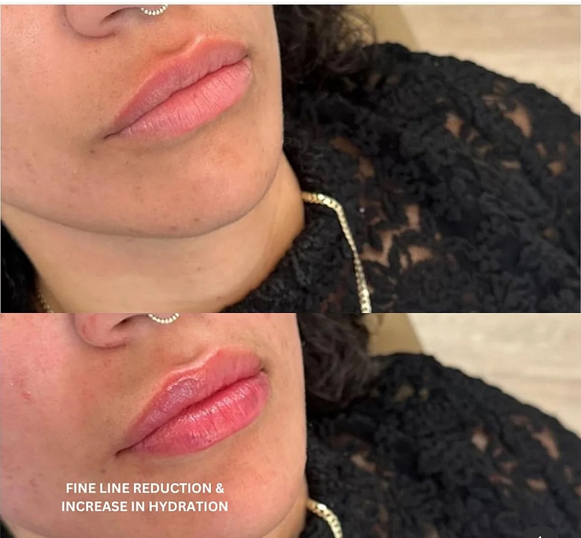 Lip enhancement before and after treatment comparison.