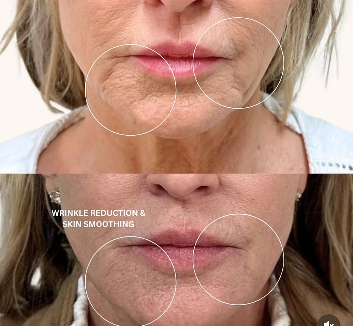 Before and after wrinkle reduction treatment results.