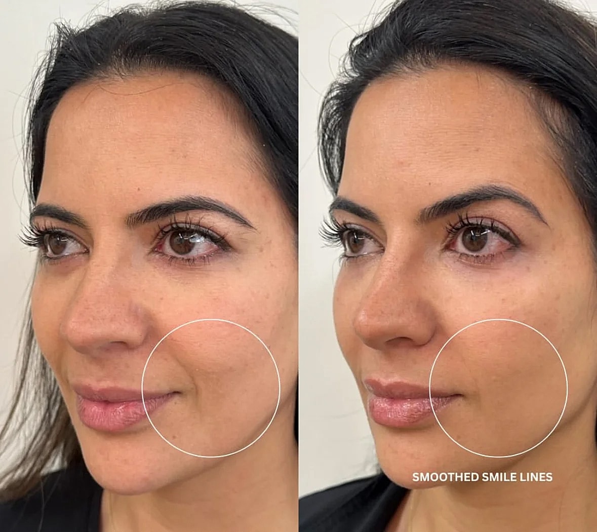 Before and after smile line treatment comparison.