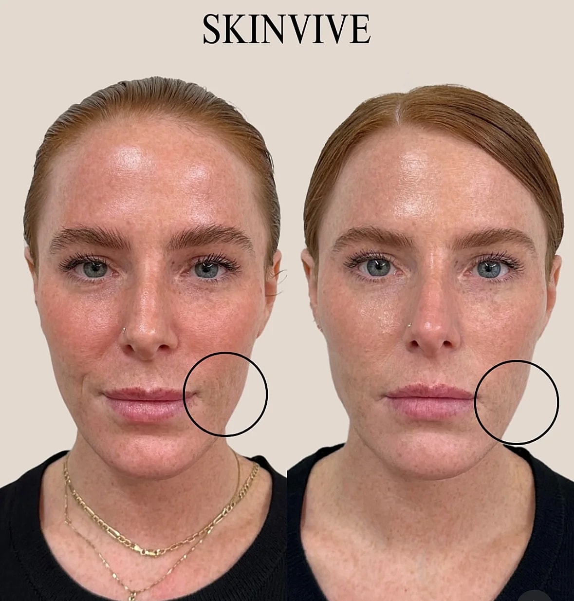 Before and after skin treatment results comparison.