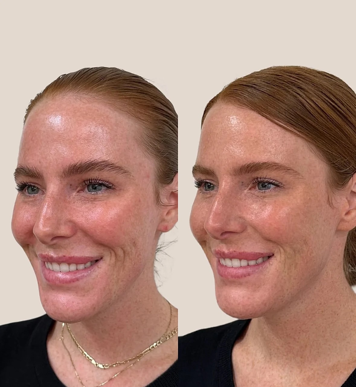 Before and after facial treatment comparison.