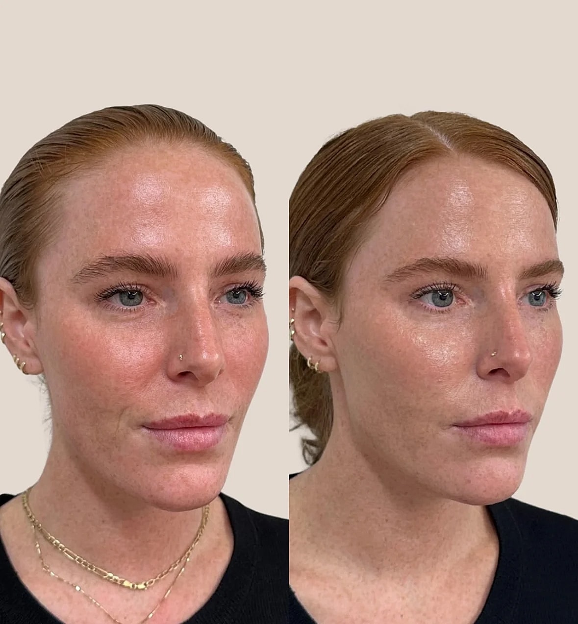 Before and after skin treatment comparison image.