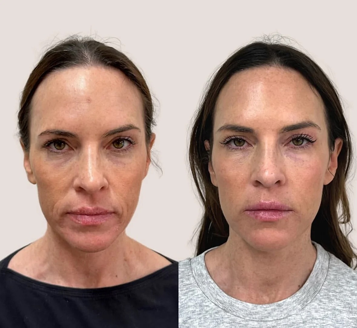 Before and after facial treatment comparison.