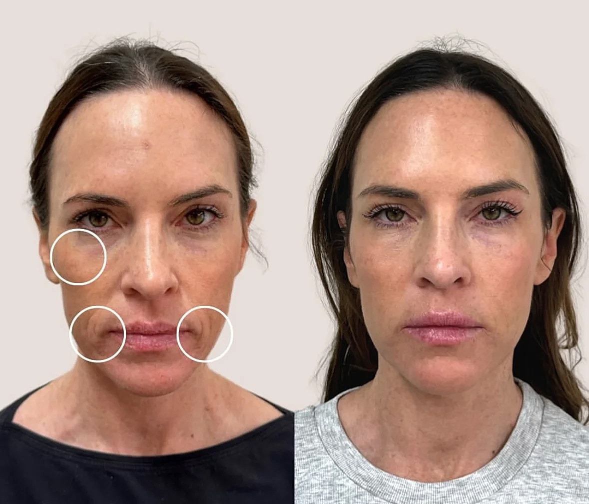 Before and after facial treatment results comparison.