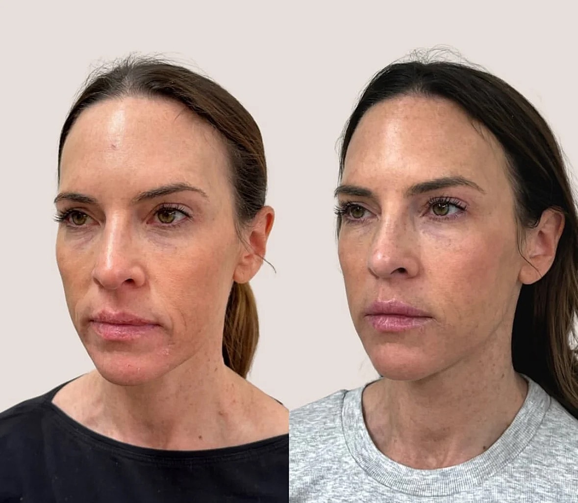 Before and after facial treatment comparison image.