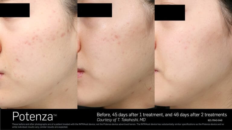 Potenza RF Microneedling Before after images by by Aere Aeshetics | Medspa in Los angeles CA and Denver CO