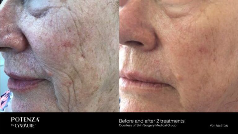 Potenza RF Microneedling Before after images by by Aere Aeshetics | Medspa in Los angeles CA and Denver CO