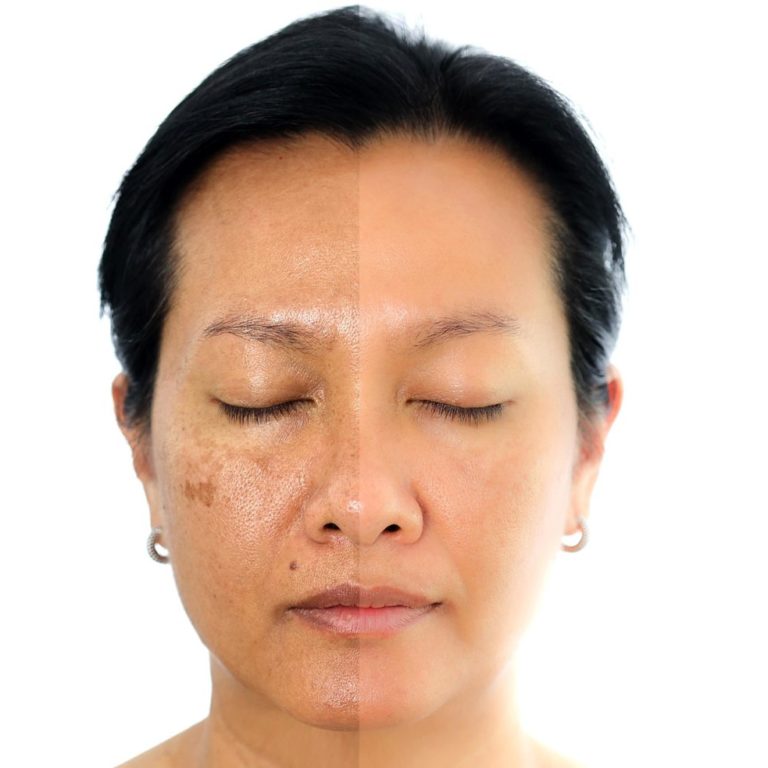 Cosmelan Depigmentation Instructions- Patient Care Instructions