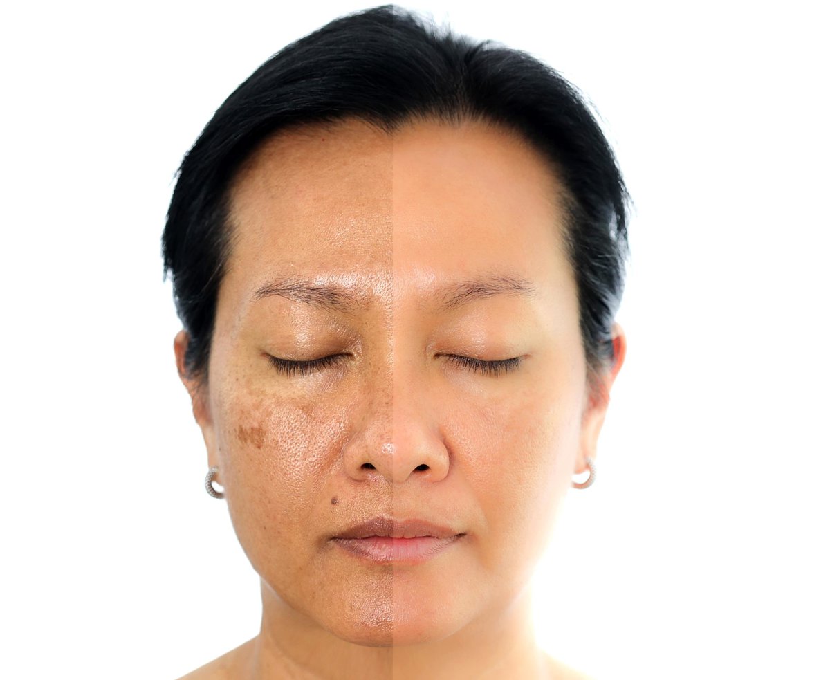 Cosmelan Depigmentation Instructions Patient Care Instructions 2 scaled