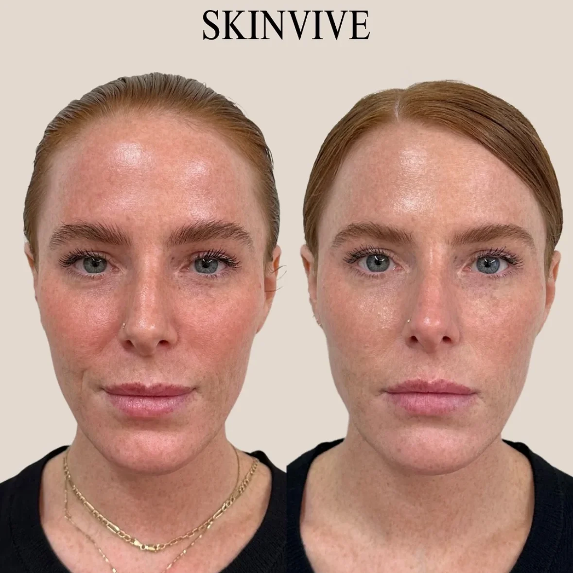 SkinviveBA1