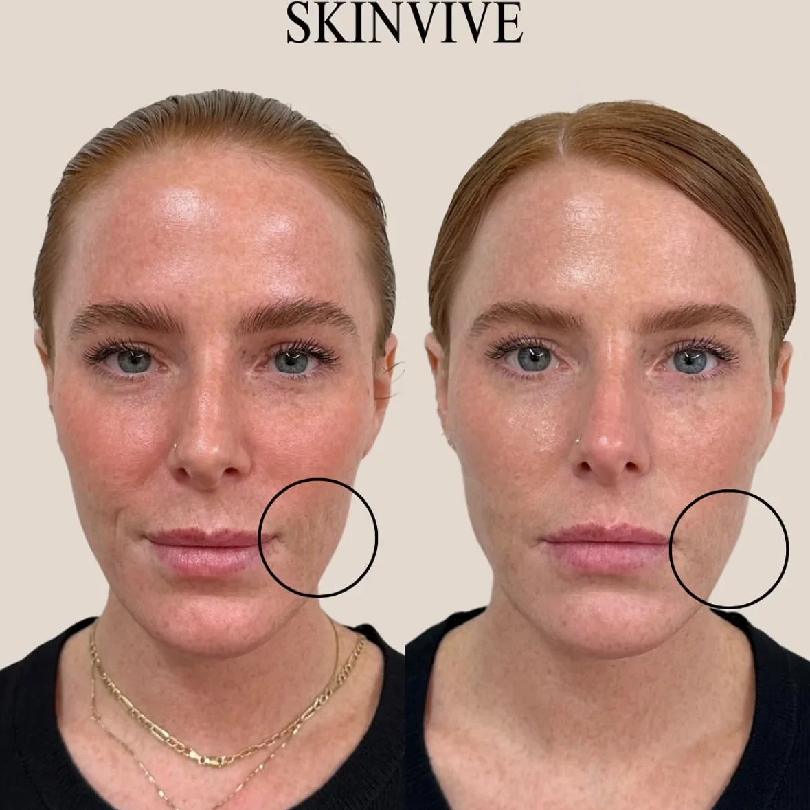 SkinviveBA2