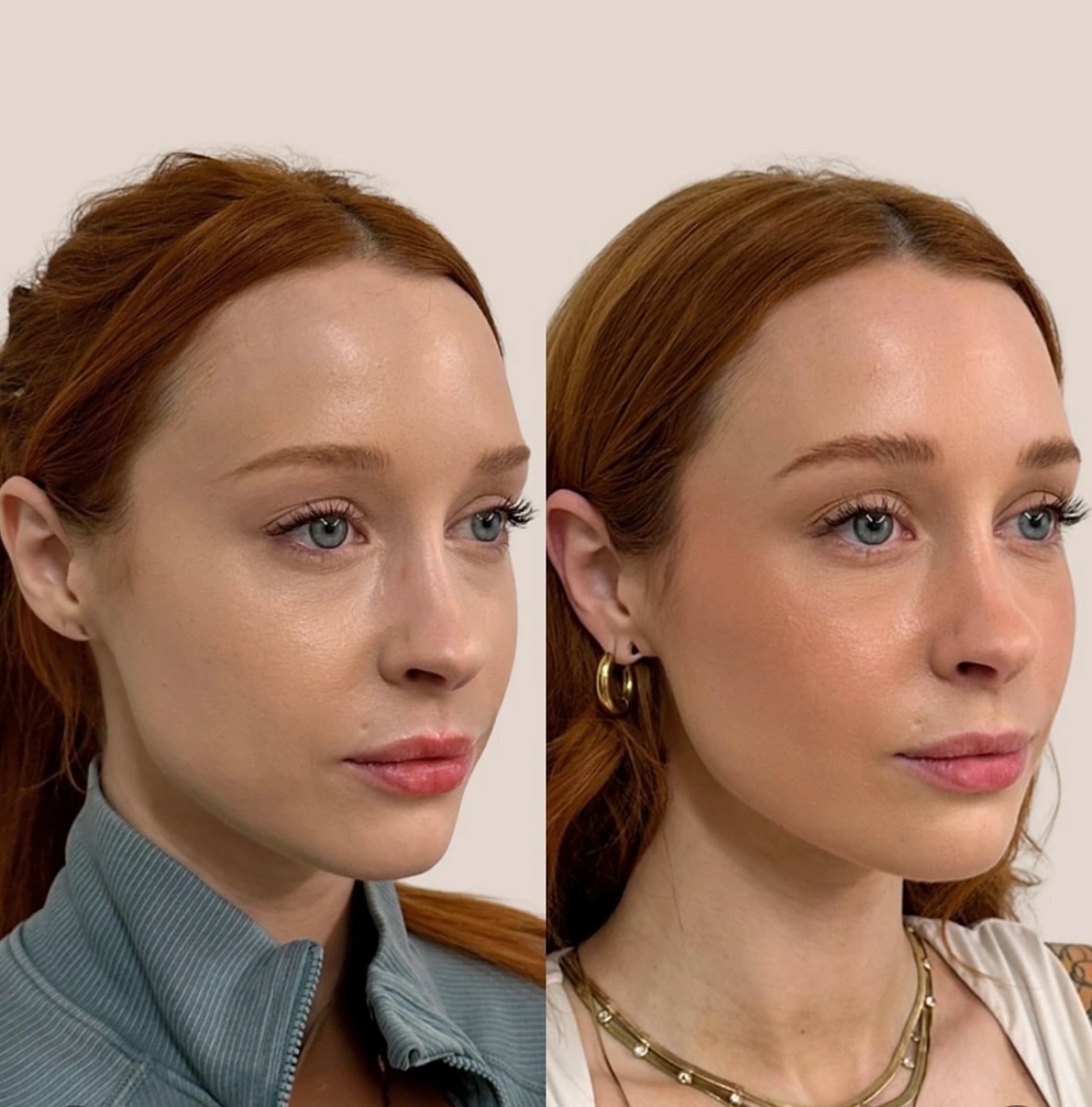 Filler before and after aereaesthetics a