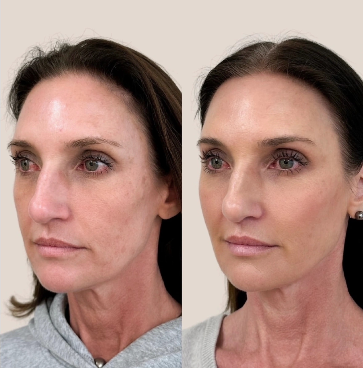 Filler before and after aereaesthetics b