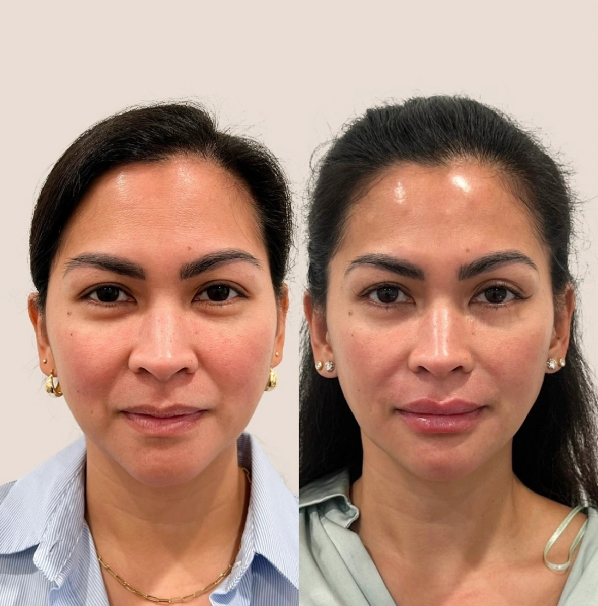 Filler before and after aereaesthetics c