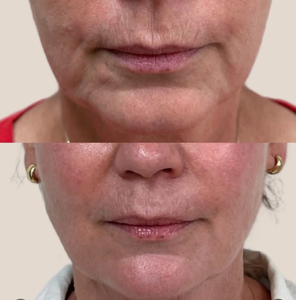 Filler before and after aereaesthetics d