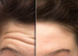 Botox or Dysport | Aere Aesthetics
