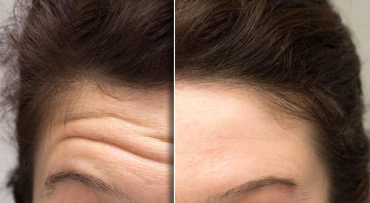 Botox or Dysport | Aere Aesthetics