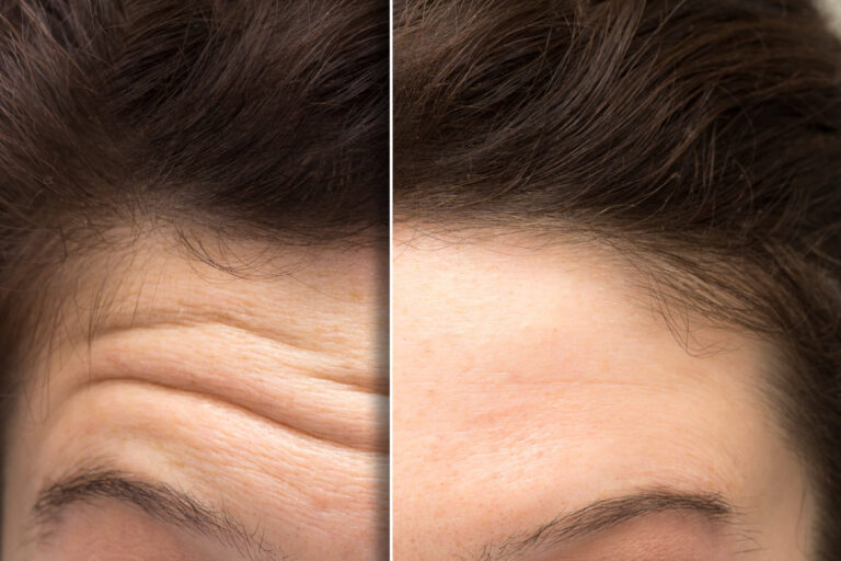 Botox or Dysport | Aere Aesthetics