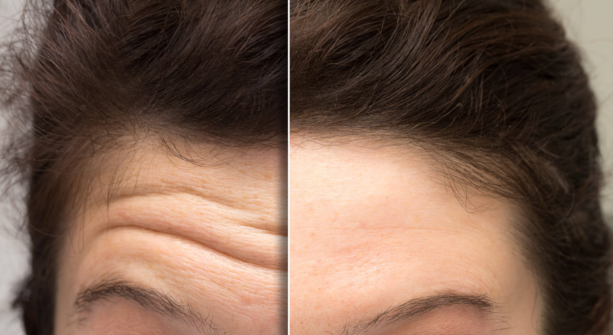 Botox or Dysport | Aere Aesthetics