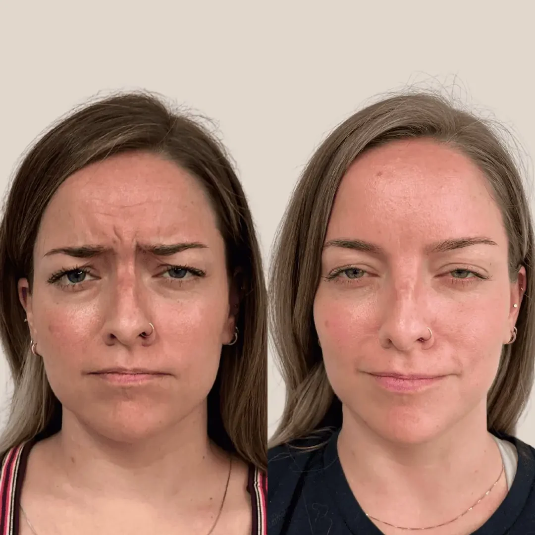 Botox Filler