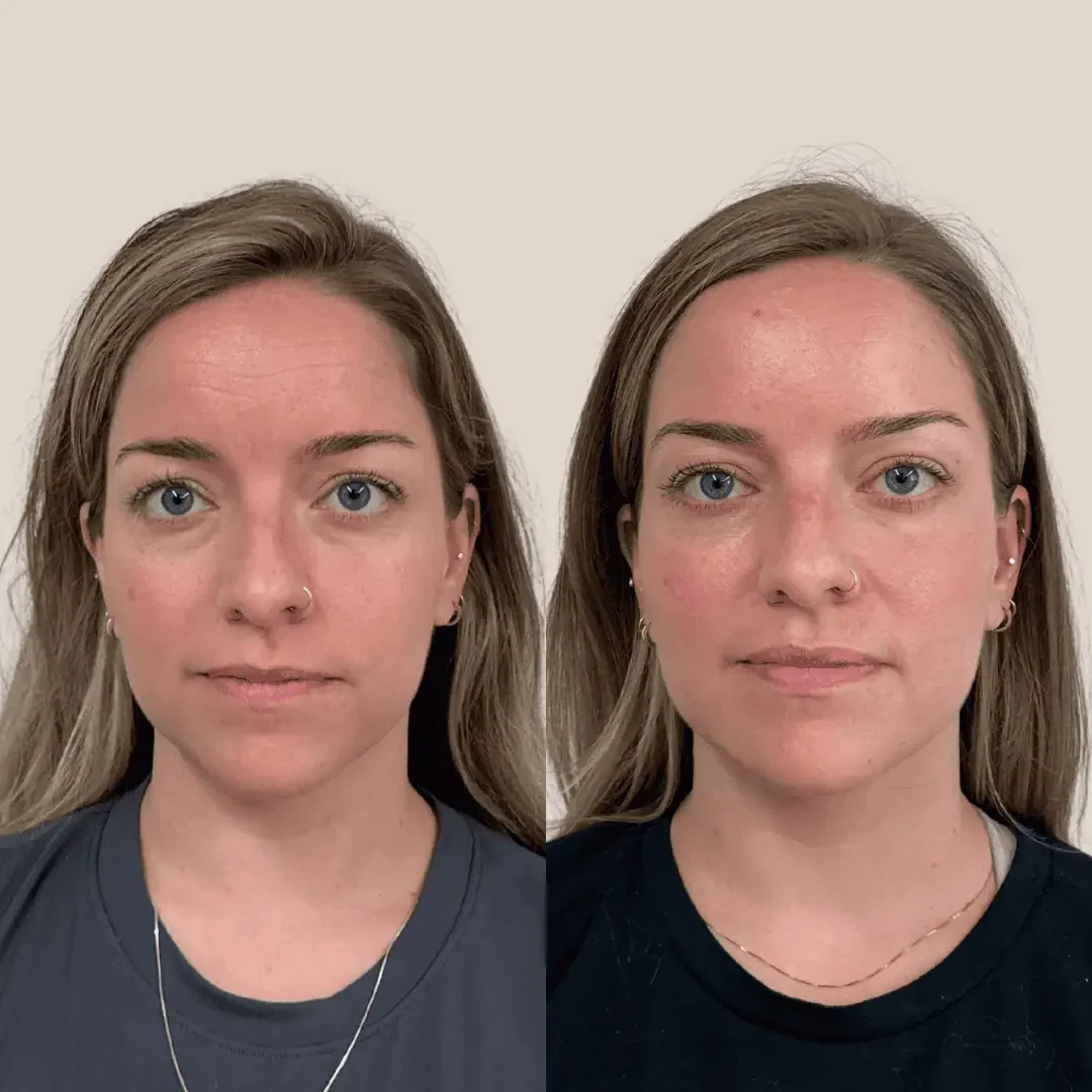 Botox and Filler