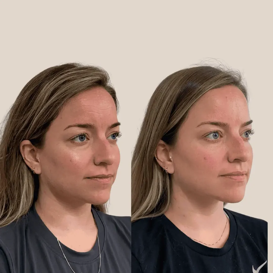 Botox and Filler BA