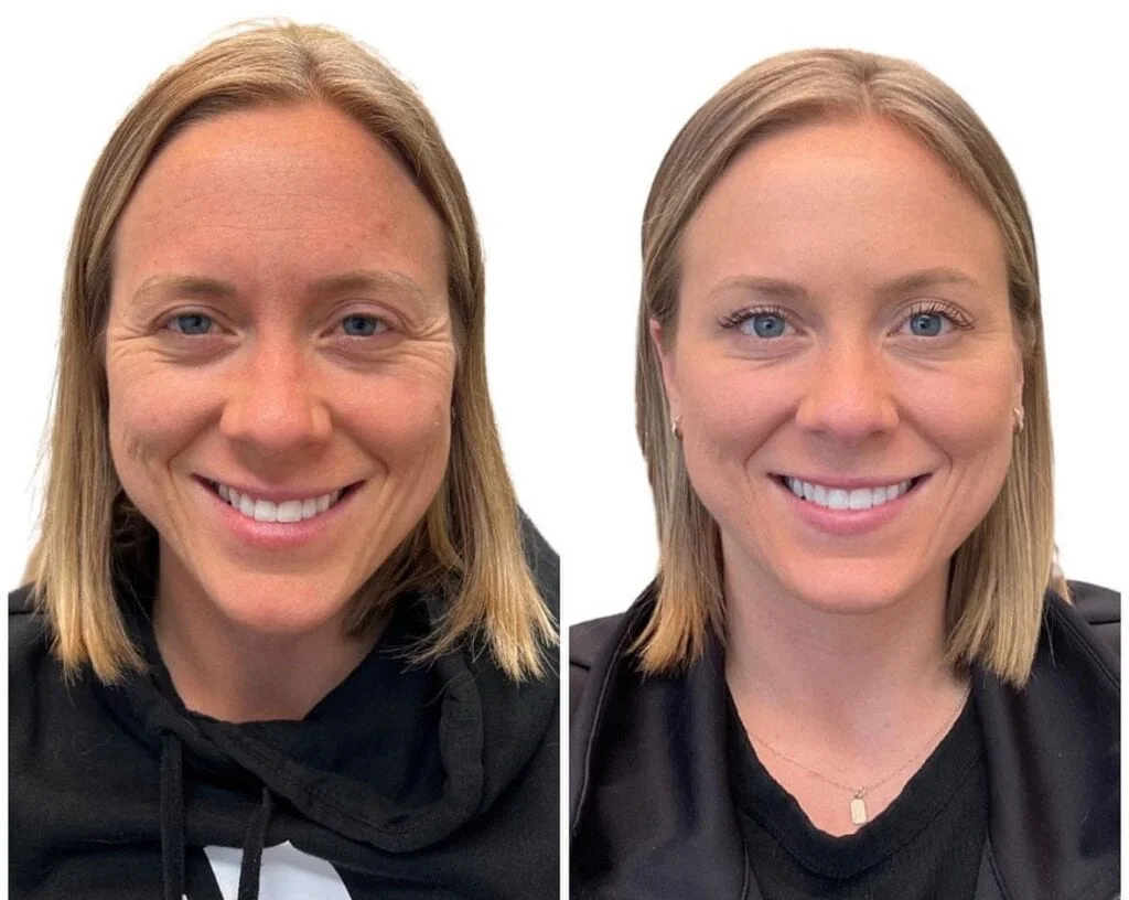 botox day before after aere aesthetics